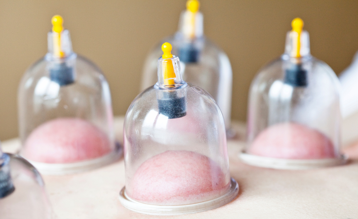 Cupping Therapy